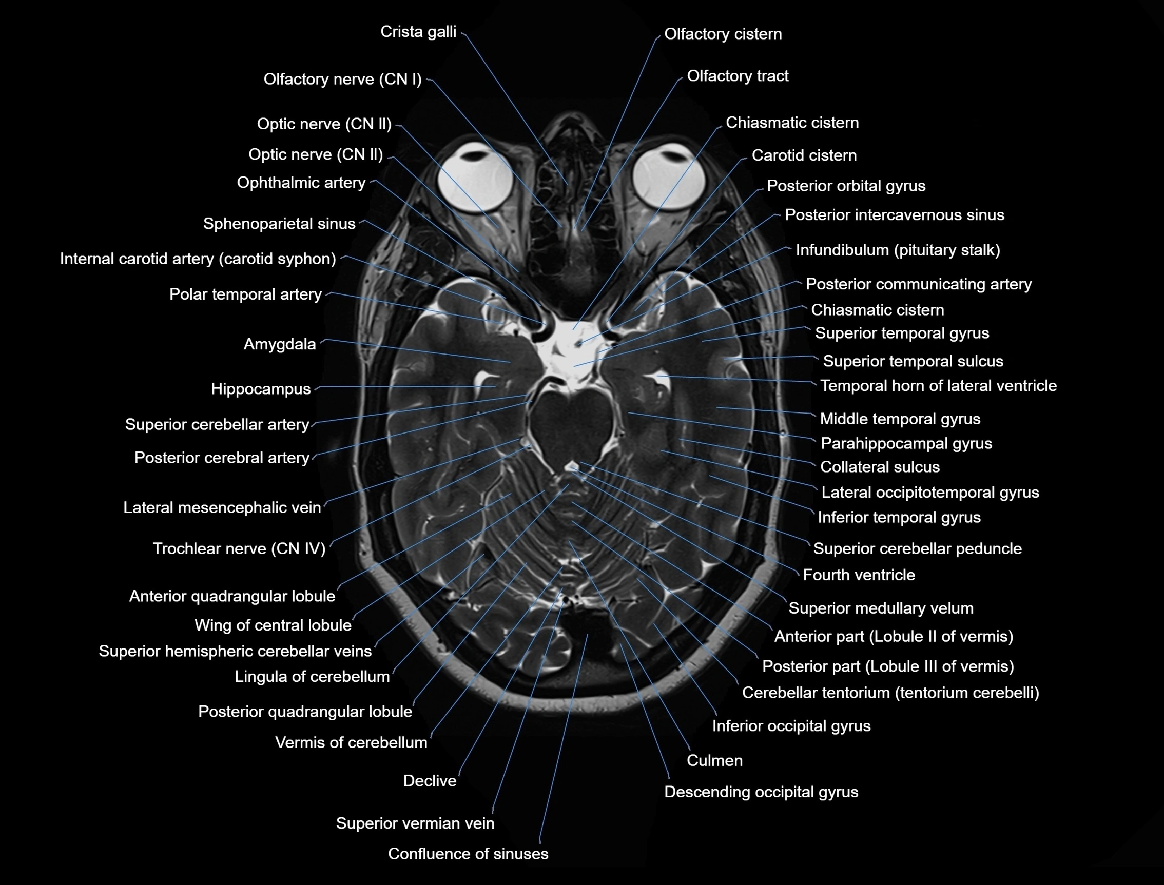 MRI Brain axial cross sectional radiology anatomy 3T image  -img-00001-00020.webp